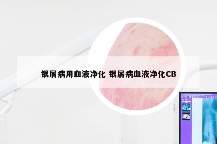 银屑病用血液净化 银屑病血液净化CB
