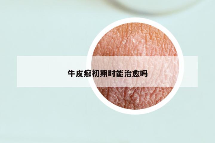 牛皮癣初期时能治愈吗