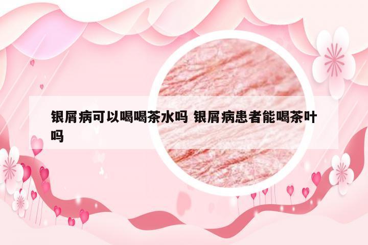 银屑病可以喝喝茶水吗 银屑病患者能喝茶叶吗