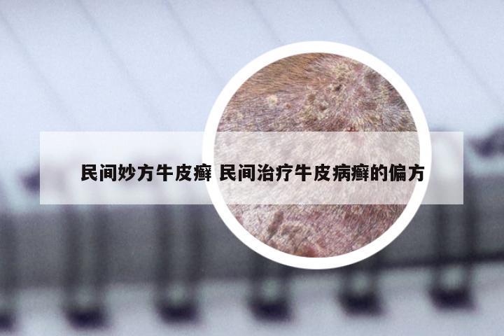 民间妙方牛皮癣 民间治疗牛皮病癣的偏方