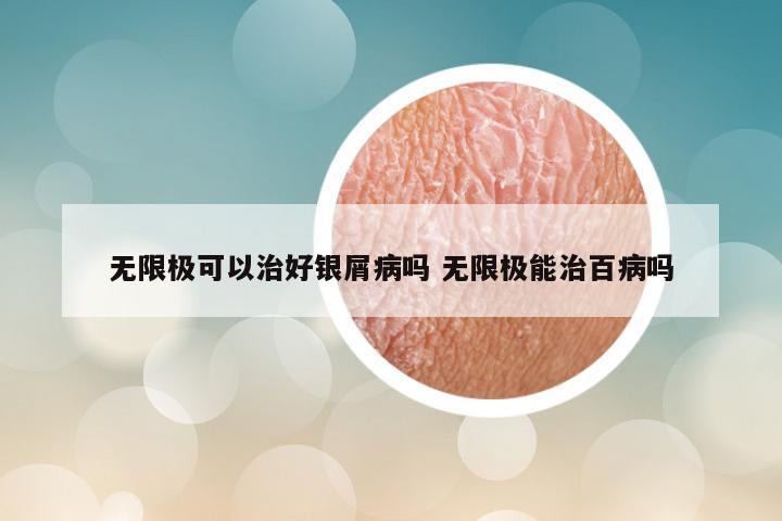无限极可以治好银屑病吗 无限极能治百病吗