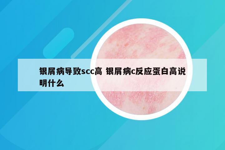银屑病导致scc高 银屑病c反应蛋白高说明什么