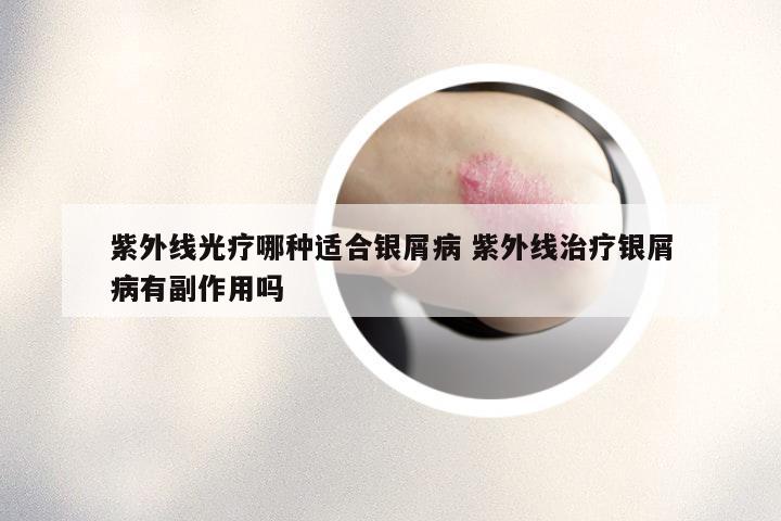 紫外线光疗哪种适合银屑病 紫外线治疗银屑病有副作用吗