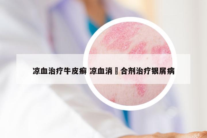 凉血治疗牛皮癣 凉血消疕合剂治疗银屑病