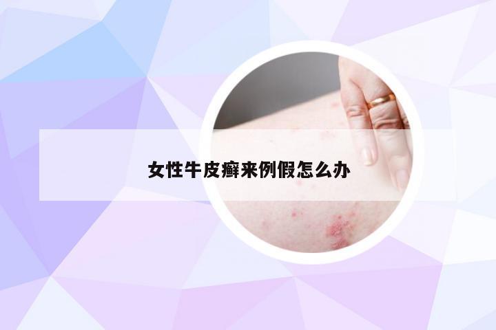 女性牛皮癣来例假怎么办