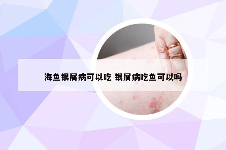 海鱼银屑病可以吃 银屑病吃鱼可以吗