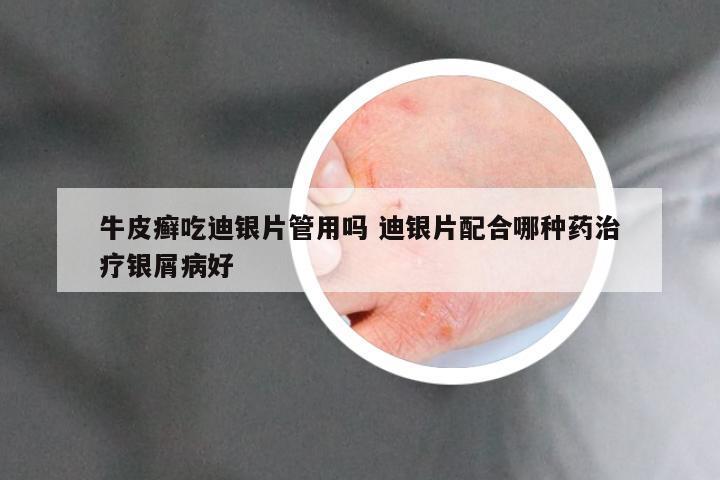 牛皮癣吃迪银片管用吗 迪银片配合哪种药治疗银屑病好