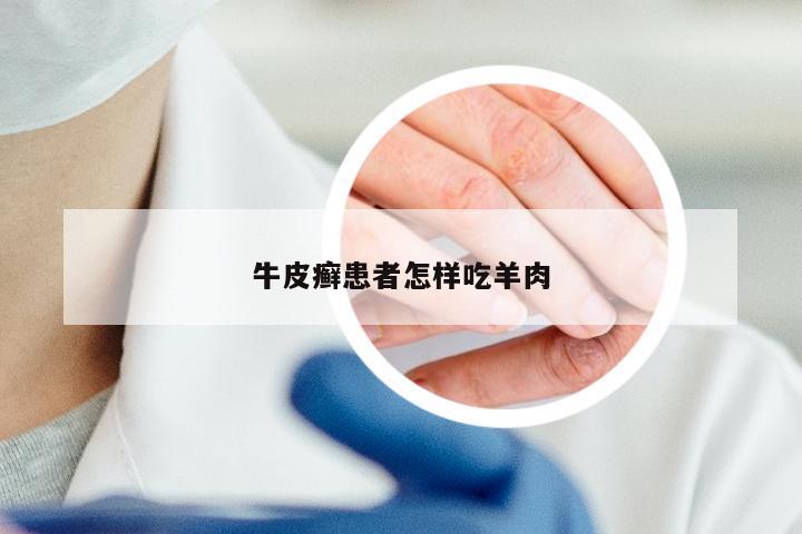 牛皮癣患者怎样吃羊肉