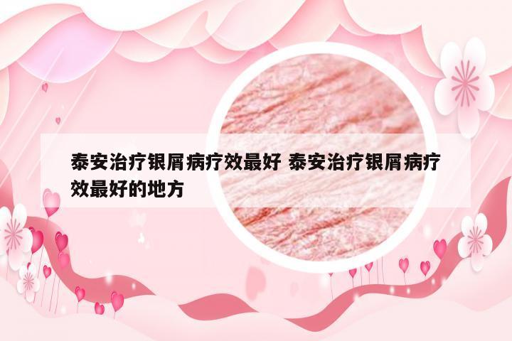 泰安治疗银屑病疗效最好 泰安治疗银屑病疗效最好的地方