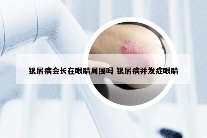 银屑病会长在眼睛周围吗 银屑病并发症眼睛
