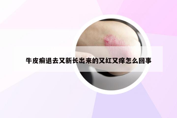 牛皮癣退去又新长出来的又红又痒怎么回事