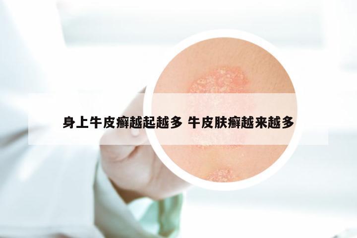 身上牛皮癣越起越多 牛皮肤癣越来越多