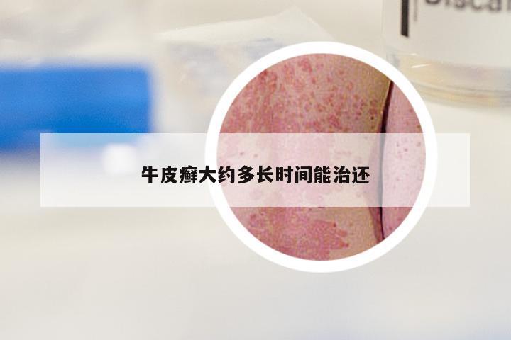 牛皮癣大约多长时间能治还