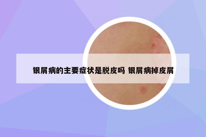 银屑病的主要症状是脱皮吗 银屑病掉皮屑