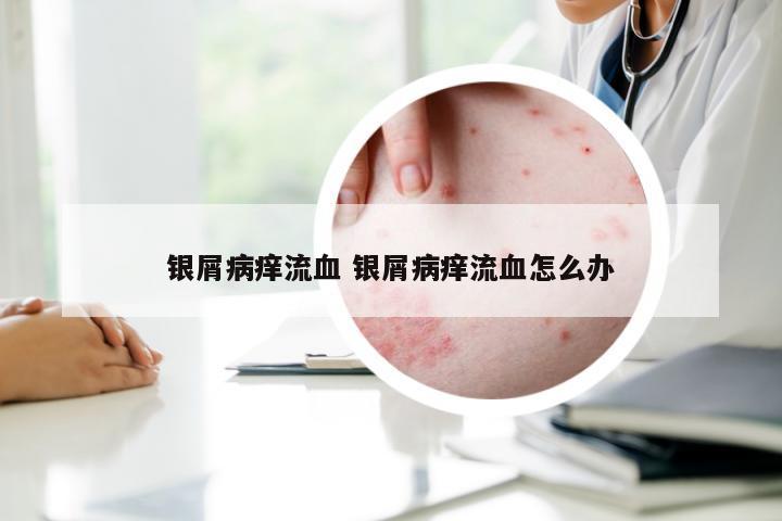 银屑病痒流血 银屑病痒流血怎么办