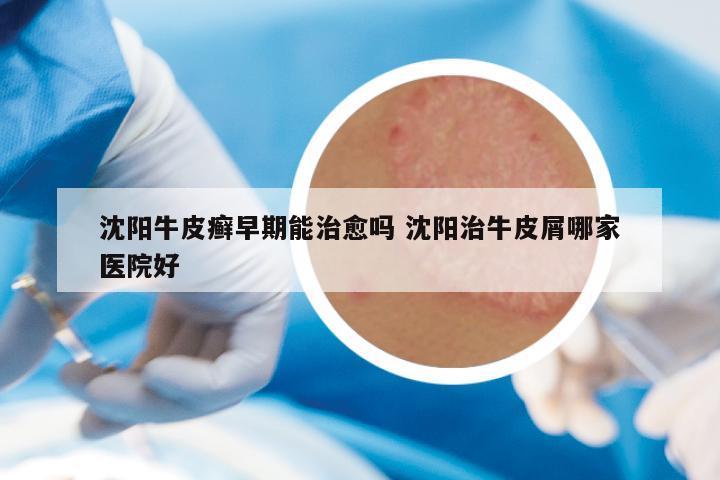 沈阳牛皮癣早期能治愈吗 沈阳治牛皮屑哪家医院好