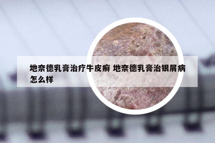 地奈德乳膏治疗牛皮癣 地奈德乳膏治银屑病怎么样