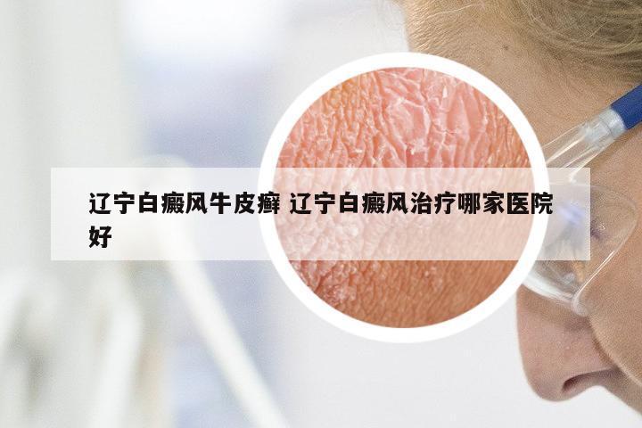 辽宁白癜风牛皮癣 辽宁白癜风治疗哪家医院好