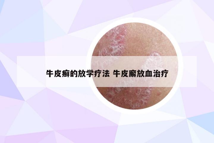 牛皮癣的放学疗法 牛皮廨放血治疗