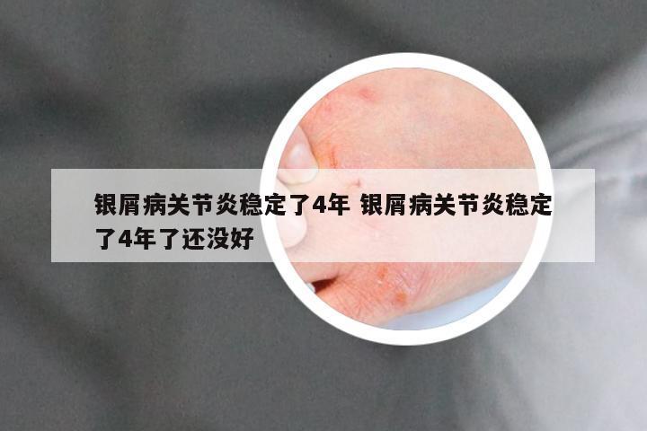 银屑病关节炎稳定了4年 银屑病关节炎稳定了4年了还没好