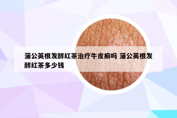 蒲公英根发酵红茶治疗牛皮癣吗 蒲公英根发酵红茶多少钱