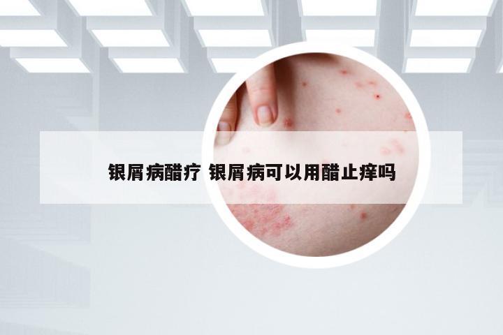 银屑病醋疗 银屑病可以用醋止痒吗