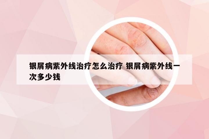银屑病紫外线治疗怎么治疗 银屑病紫外线一次多少钱