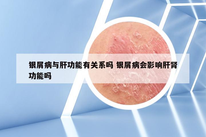 银屑病与肝功能有关系吗 银屑病会影响肝肾功能吗