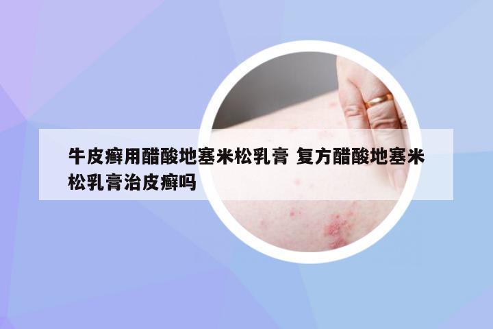 牛皮癣用醋酸地塞米松乳膏 复方醋酸地塞米松乳膏治皮癣吗