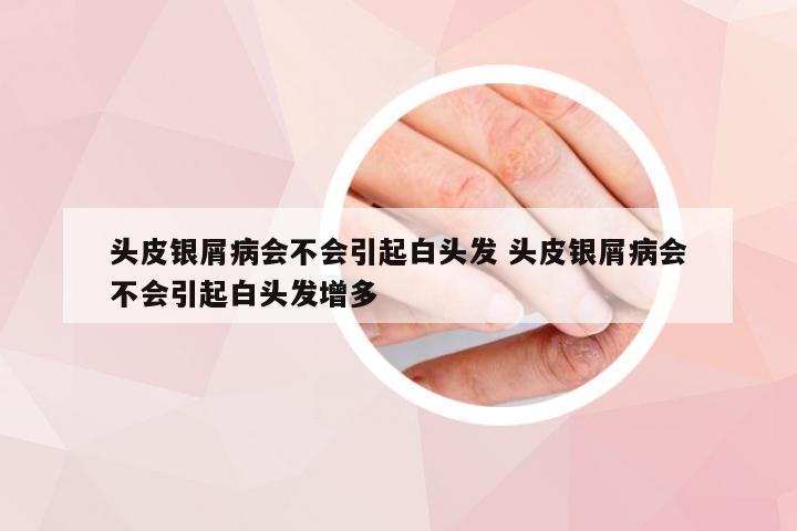头皮银屑病会不会引起白头发 头皮银屑病会不会引起白头发增多
