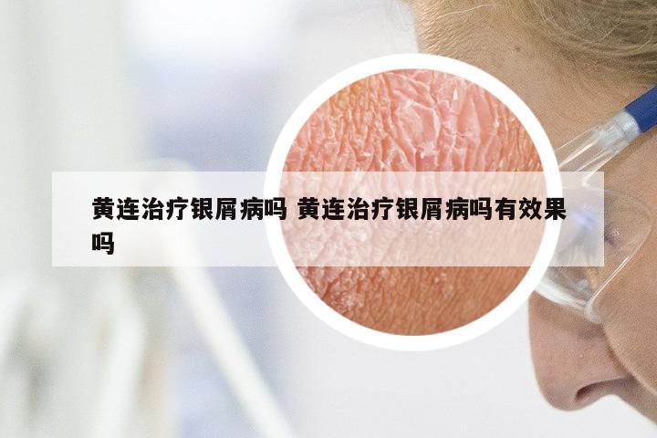 黄连治疗银屑病吗 黄连治疗银屑病吗有效果吗