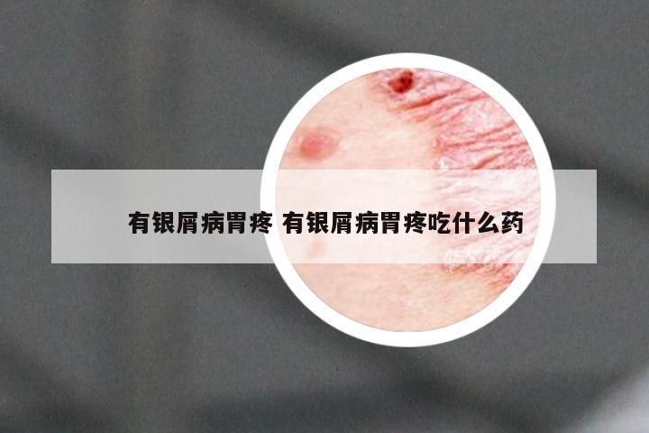 有银屑病胃疼 有银屑病胃疼吃什么药