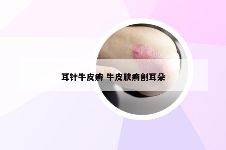 耳针牛皮癣 牛皮肤癣割耳朵