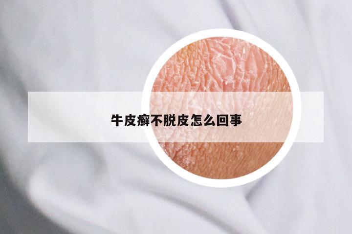 牛皮癣不脱皮怎么回事