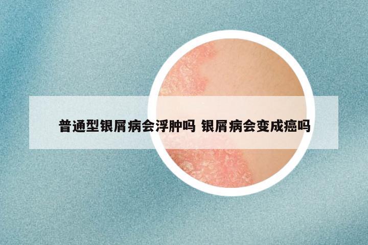 普通型银屑病会浮肿吗 银屑病会变成癌吗