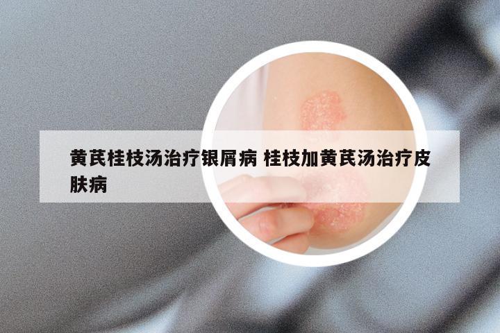 黄芪桂枝汤治疗银屑病 桂枝加黄芪汤治疗皮肤病