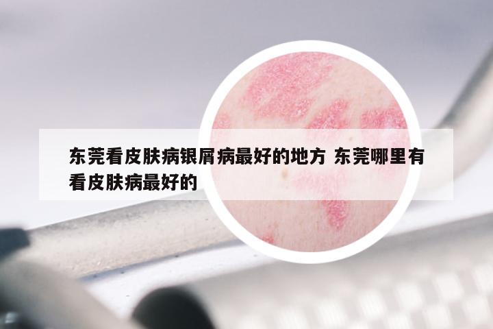 东莞看皮肤病银屑病最好的地方 东莞哪里有看皮肤病最好的