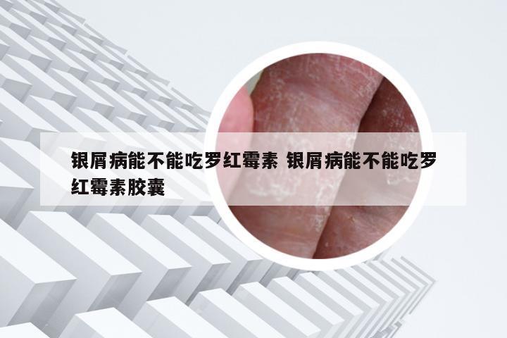 银屑病能不能吃罗红霉素 银屑病能不能吃罗红霉素胶囊
