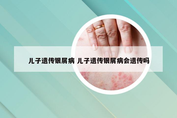 儿子遗传银屑病 儿子遗传银屑病会遗传吗