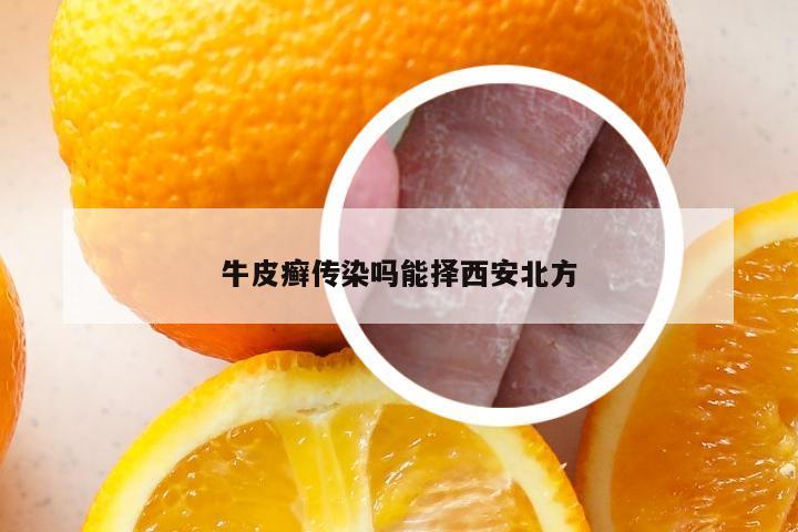 牛皮癣传染吗能择西安北方