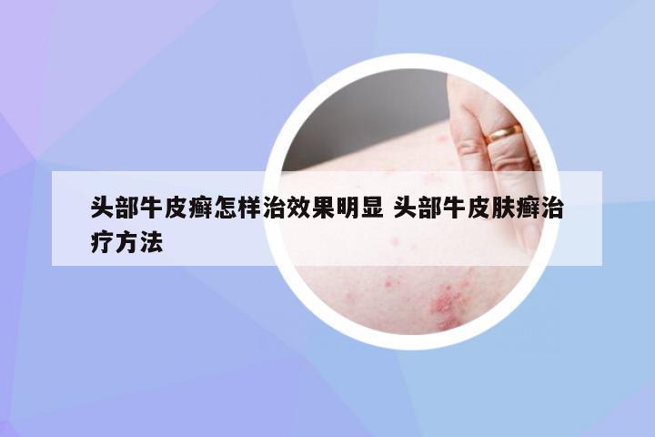 头部牛皮癣怎样治效果明显 头部牛皮肤癣治疗方法