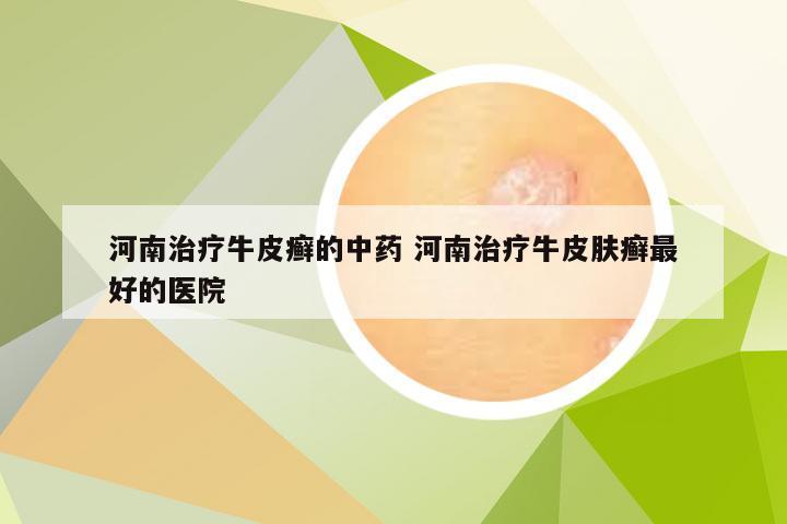 河南治疗牛皮癣的中药 河南治疗牛皮肤癣最好的医院