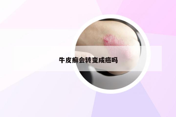 牛皮癣会转变成癌吗