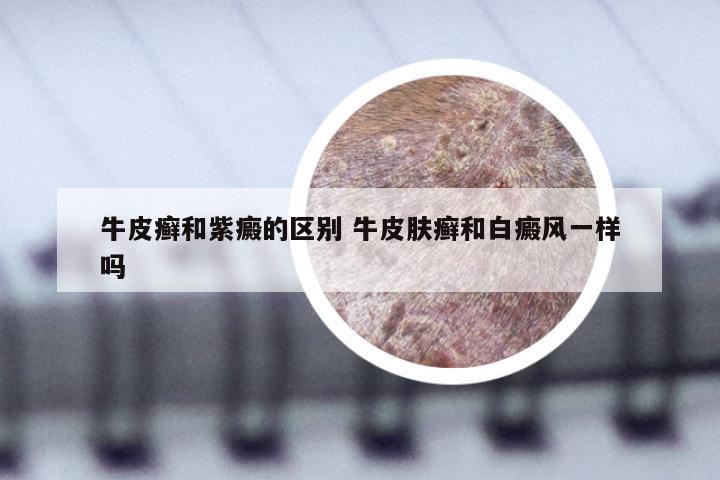 牛皮癣和紫癜的区别 牛皮肤癣和白癜风一样吗