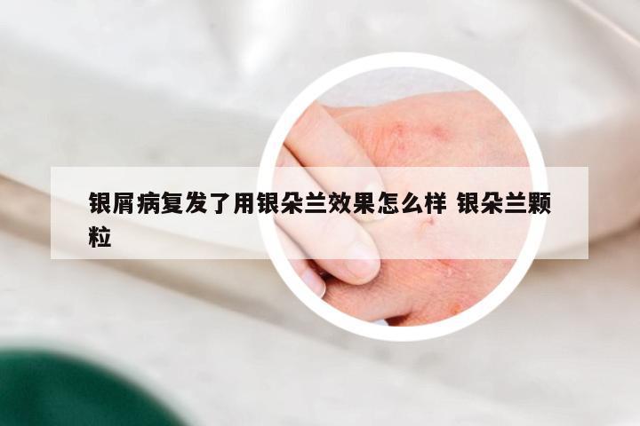 银屑病复发了用银朵兰效果怎么样 银朵兰颗粒