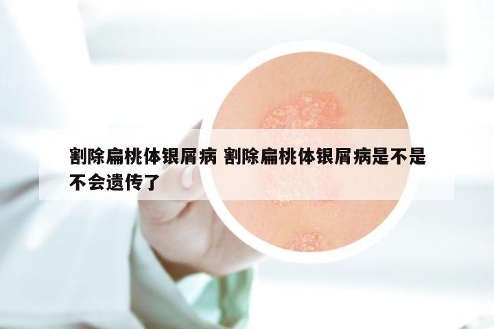 割除扁桃体银屑病 割除扁桃体银屑病是不是不会遗传了