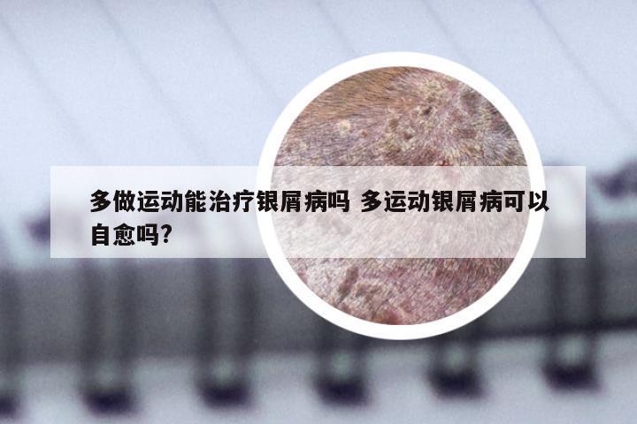 多做运动能治疗银屑病吗 多运动银屑病可以自愈吗?