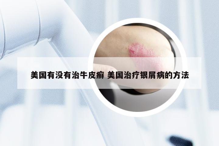 美国有没有治牛皮癣 美国治疗银屑病的方法