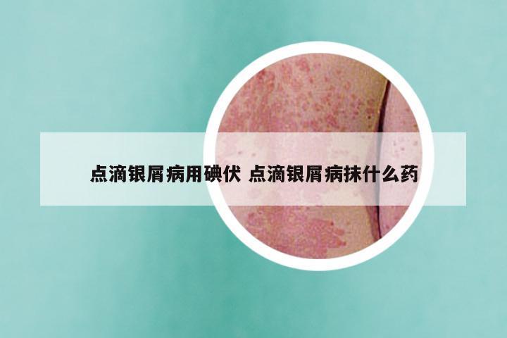点滴银屑病用碘伏 点滴银屑病抹什么药