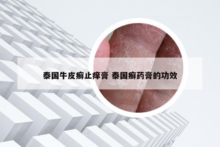 泰国牛皮癣止痒膏 泰国癣药膏的功效